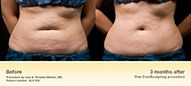 CoolSculpting
